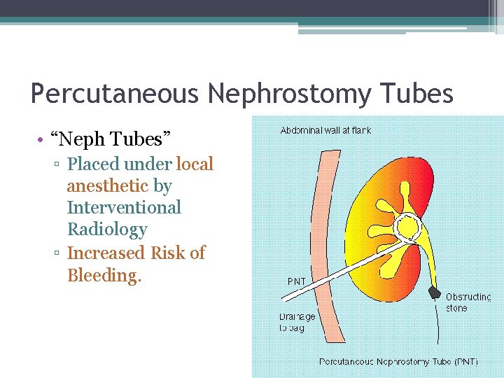 Percutaneous Nephrostomy Tubes • “Neph Tubes” ▫ Placed under local anesthetic by Interventional Radiology