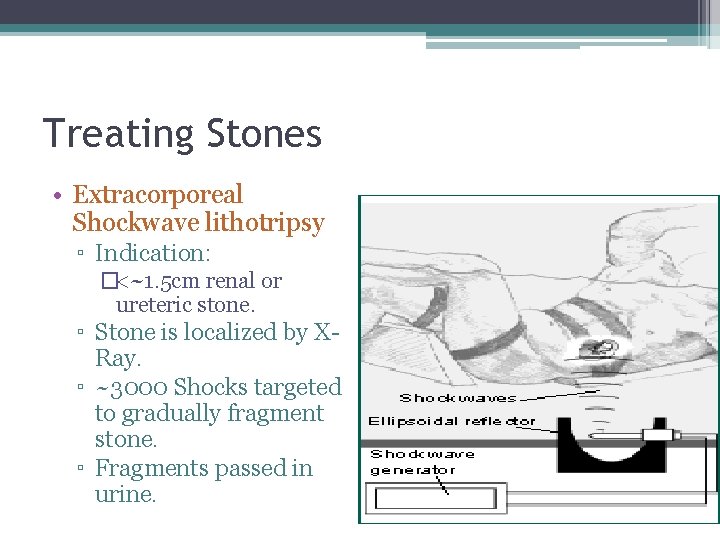 Treating Stones • Extracorporeal Shockwave lithotripsy ▫ Indication: �<~1. 5 cm renal or ureteric