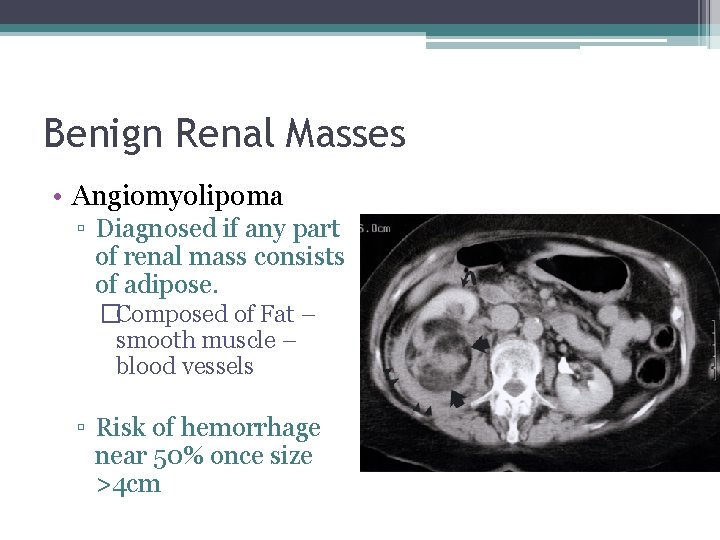 Benign Renal Masses • Angiomyolipoma ▫ Diagnosed if any part of renal mass consists