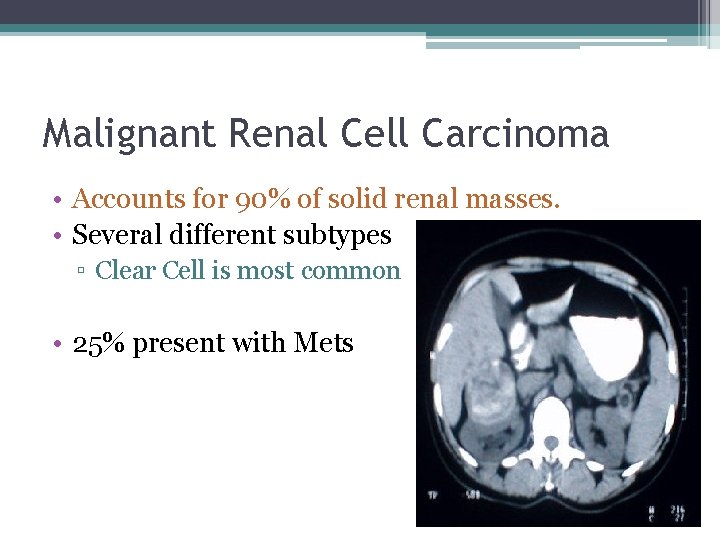 Malignant Renal Cell Carcinoma • Accounts for 90% of solid renal masses. • Several