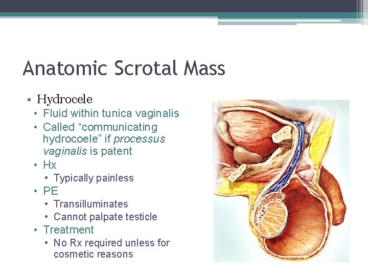 Anatomic Scrotal Mass • Hydrocele • Fluid within tunica vaginalis • Called “communicating hydrocoele”