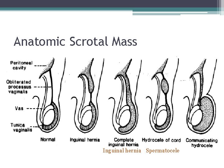 Anatomic Scrotal Mass Inguinal hernia Spermatocele 