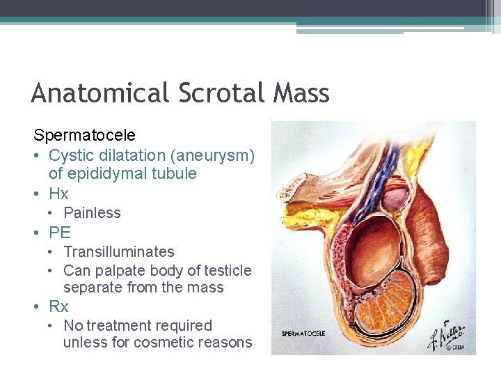 Anatomical Scrotal Mass Spermatocele • Cystic dilatation (aneurysm) of epididymal tubule • Hx •