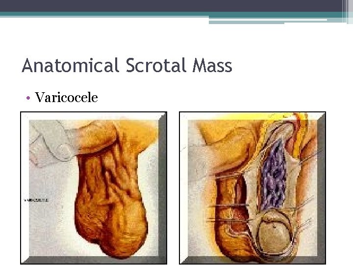 Anatomical Scrotal Mass • Varicocele 