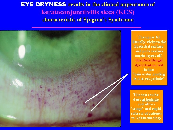 EYE DRYNESS results in the clinical appearance of keratoconjunctivitis sicca (KCS) characteristic of Sjogren’s