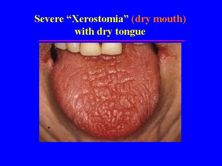 Severe “Xerostomia” (dry mouth) with dry tongue 