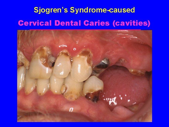 Sjogren’s Syndrome-caused Cervical Dental Caries (cavities) 