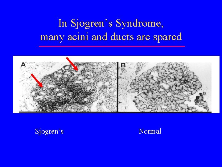 In Sjogren’s Syndrome, many acini and ducts are spared Sjogren’s Normal 