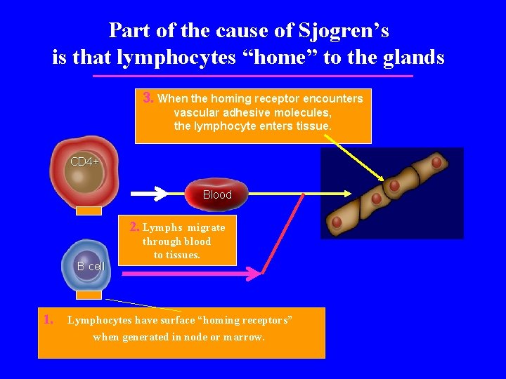 Part of the cause of Sjogren’s is that lymphocytes “home” to the glands 3.