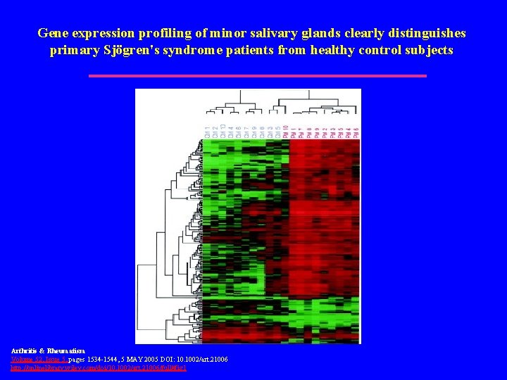 Gene expression profiling of minor salivary glands clearly distinguishes primary Sjögren's syndrome patients from