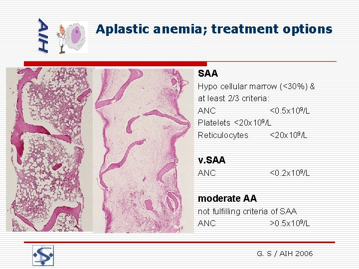 Aplastic anemia; treatment options SAA Hypo cellular marrow (<30%) & at least 2/3 criteria: