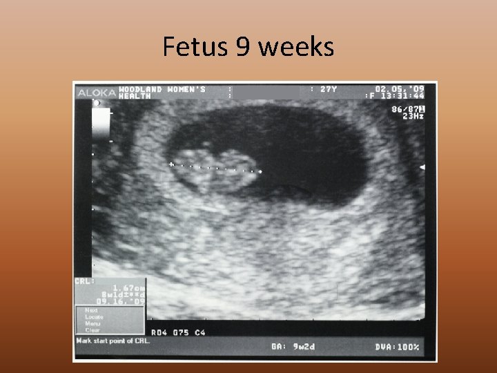 Fetus 9 weeks 