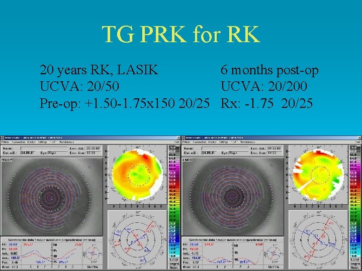 TG PRK for RK 20 years RK, LASIK 6 months post-op UCVA: 20/50 UCVA: