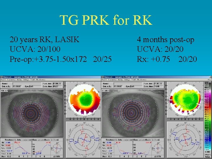 TG PRK for RK 20 years RK, LASIK UCVA: 20/100 Pre-op: +3. 75 -1.