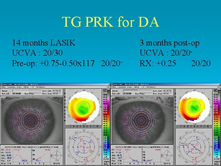 TG PRK for DA 14 months LASIK UCVA : 20/30 Pre-op: +0. 75 -0.