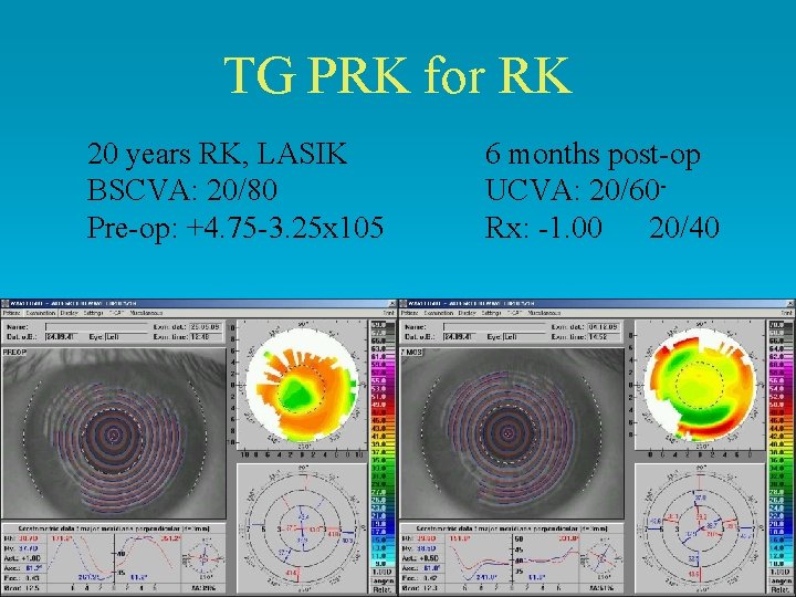 TG PRK for RK 20 years RK, LASIK BSCVA: 20/80 Pre-op: +4. 75 -3.