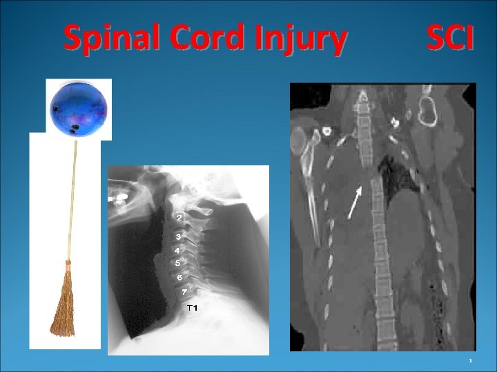 Spinal Cord Injury SCI 1 