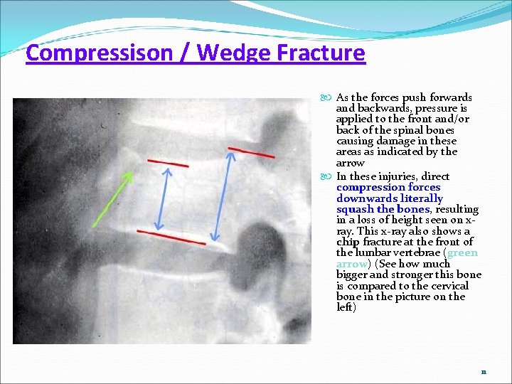 Compressison / Wedge Fracture As the forces push forwards and backwards, pressure is applied