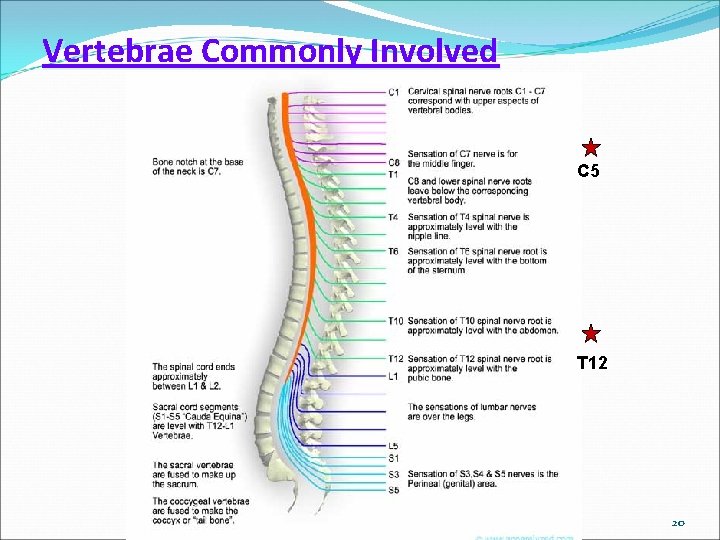 Vertebrae Commonly Involved C 5 T 12 20 