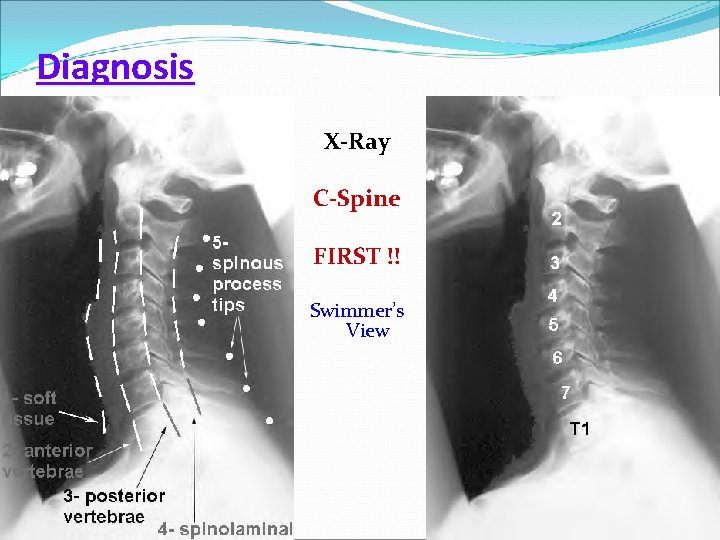 Diagnosis X-Ray C-Spine FIRST !! Swimmer’s View 22 