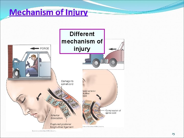 Mechanism of Injury Different mechanism of injury 25 