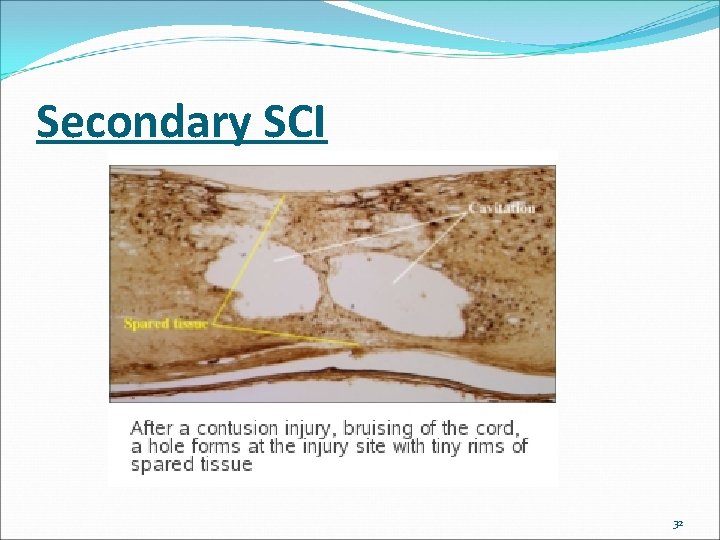 Secondary SCI 32 