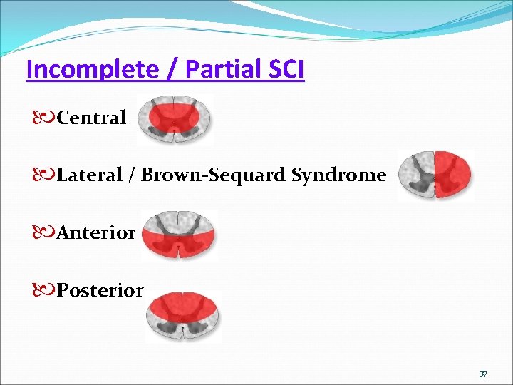 Incomplete / Partial SCI Central Lateral / Brown-Sequard Syndrome Anterior Posterior 37 