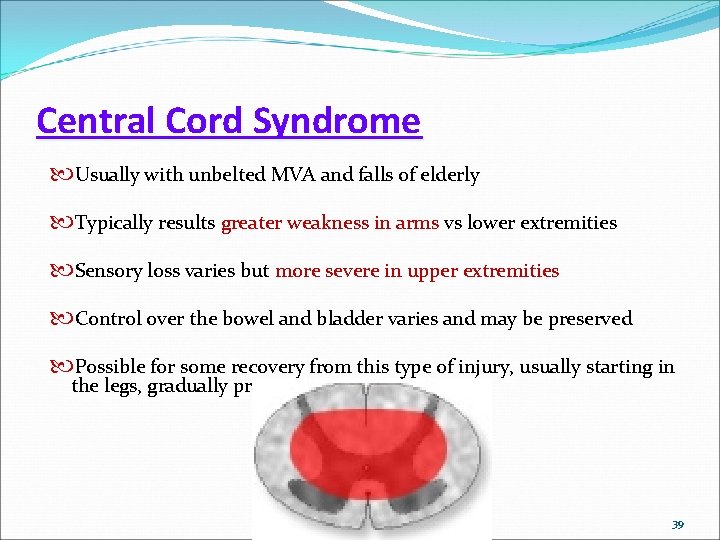 Central Cord Syndrome Usually with unbelted MVA and falls of elderly Typically results greater