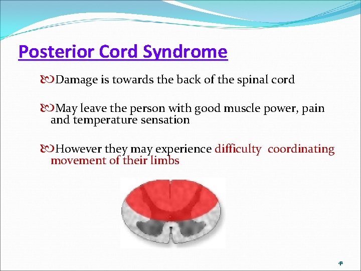 Posterior Cord Syndrome Damage is towards the back of the spinal cord May leave