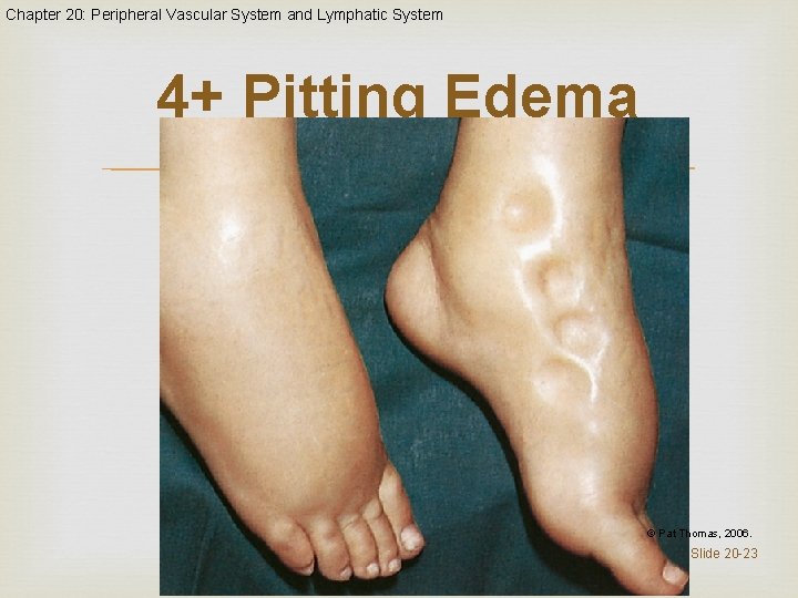 Chapter 20: Peripheral Vascular System and Lymphatic System 4+ Pitting Edema © Pat Thomas,
