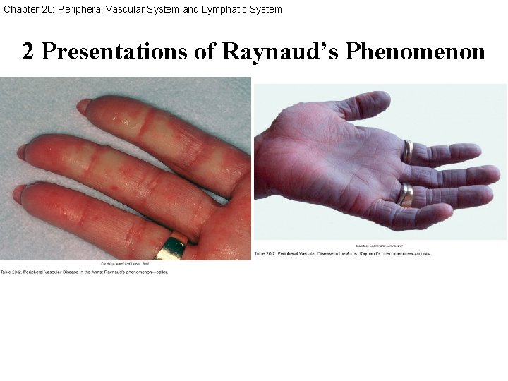 Chapter 20: Peripheral Vascular System and Lymphatic System 2 Presentations of Raynaud’s Phenomenon 