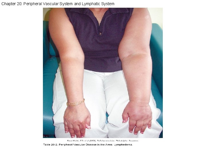 Chapter 20: Peripheral Vascular System and Lymphatic System 