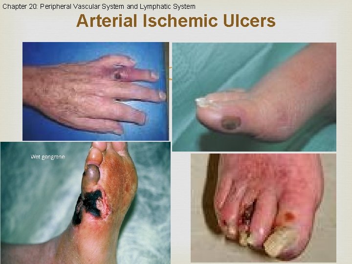 Chapter 20: Peripheral Vascular System and Lymphatic System Arterial Ischemic Ulcers Slide 20 -30