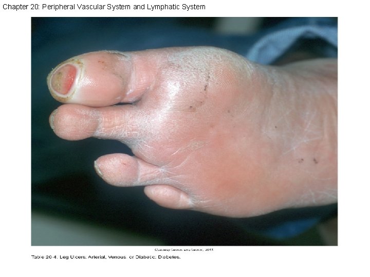 Chapter 20: Peripheral Vascular System and Lymphatic System 