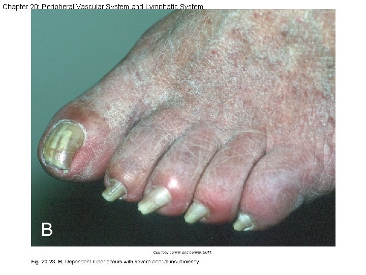 Chapter 20: Peripheral Vascular System and Lymphatic System 