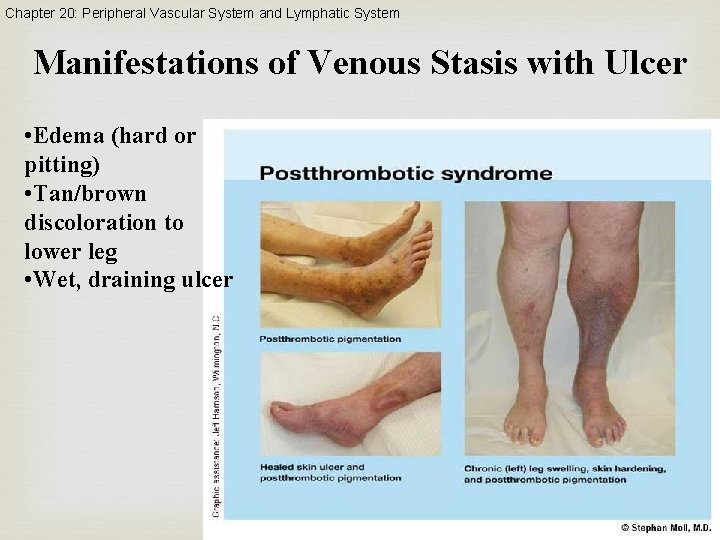 Chapter 20: Peripheral Vascular System and Lymphatic System Manifestations of Venous Stasis with Ulcer