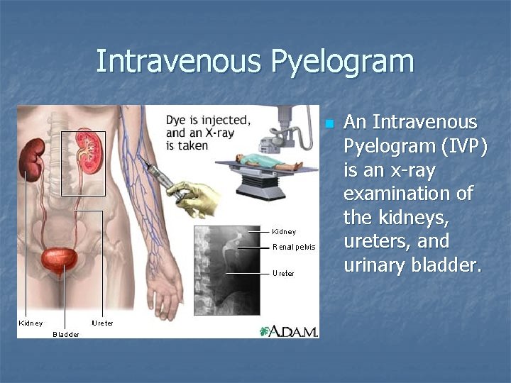 Intravenous Pyelogram n An Intravenous Pyelogram (IVP) is an x-ray examination of the kidneys,