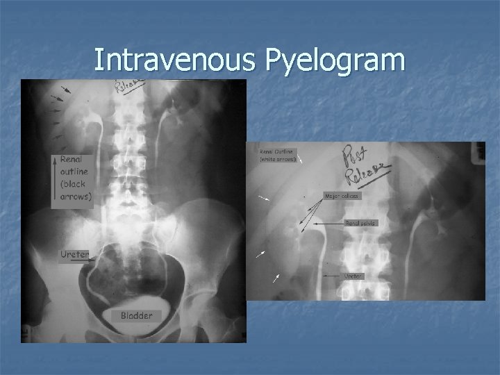 Intravenous Pyelogram 