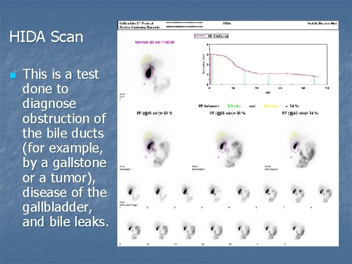 HIDA Scan n This is a test done to diagnose obstruction of the bile