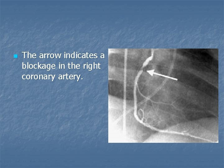 n The arrow indicates a blockage in the right coronary artery. 