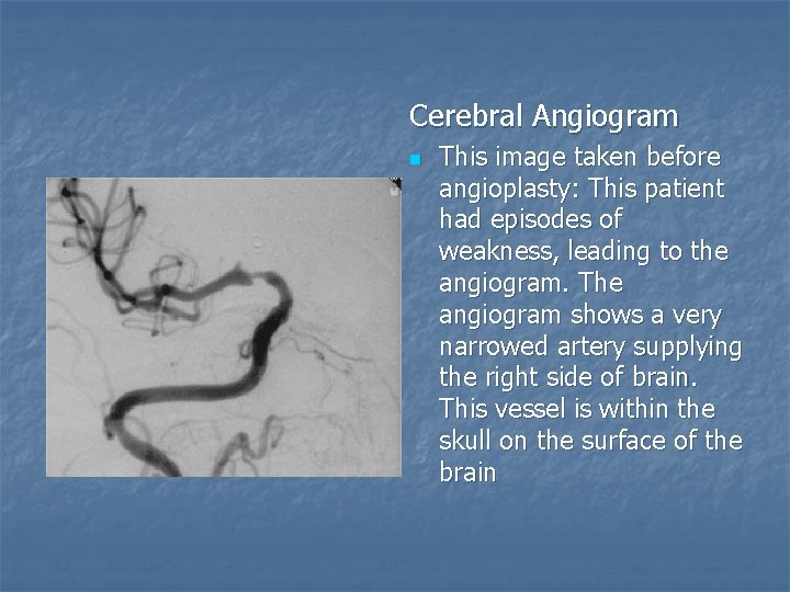 Cerebral Angiogram n This image taken before angioplasty: This patient had episodes of weakness,