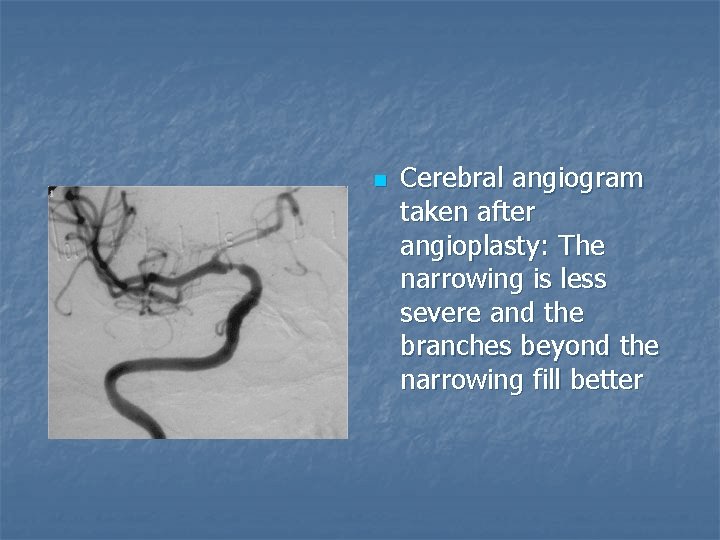 n Cerebral angiogram taken after angioplasty: The narrowing is less severe and the branches