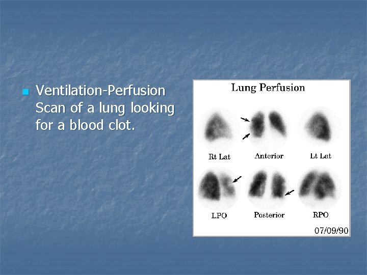 n Ventilation-Perfusion Scan of a lung looking for a blood clot. 