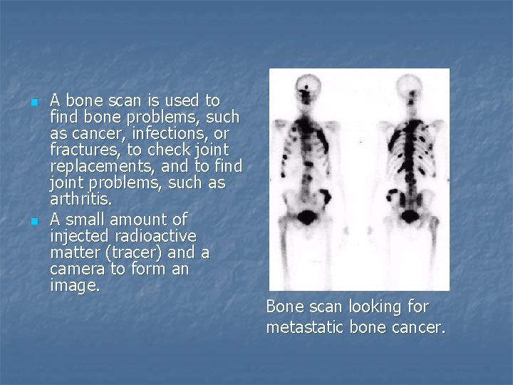 n n A bone scan is used to find bone problems, such as cancer,