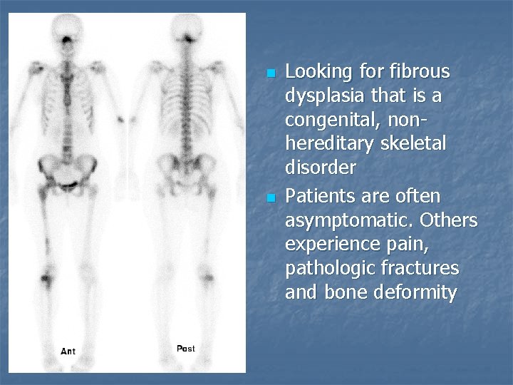 n n Looking for fibrous dysplasia that is a congenital, nonhereditary skeletal disorder Patients