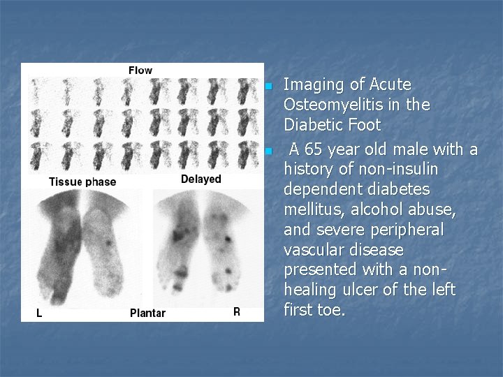 n n Imaging of Acute Osteomyelitis in the Diabetic Foot A 65 year old