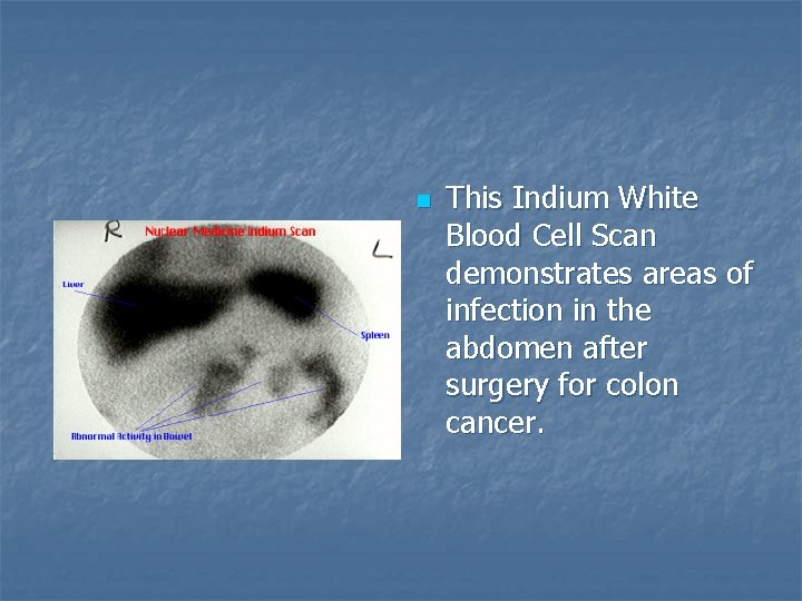 n This Indium White Blood Cell Scan demonstrates areas of infection in the abdomen