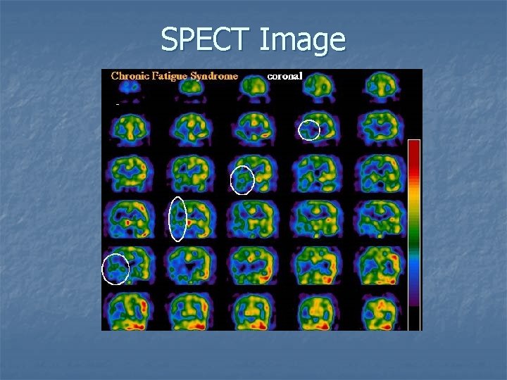 SPECT Image 