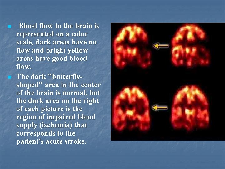 n n Blood flow to the brain is represented on a color scale, dark