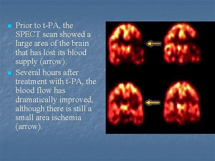 n n Prior to t-PA, the SPECT scan showed a large area of the